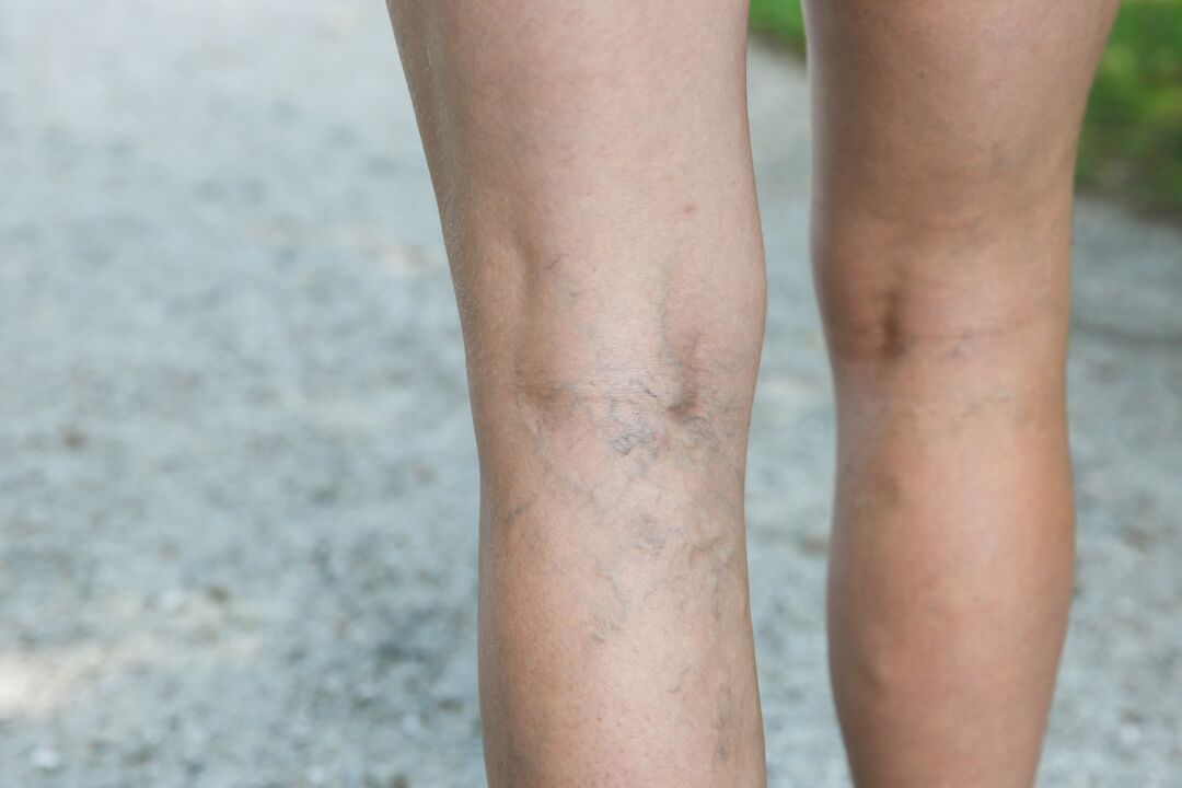With varicose veins, an exercise program should be discussed with a doctor. 
